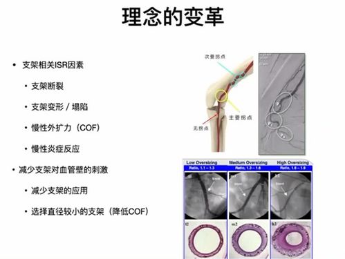 叶志东教授 谈载药支架在支架内再狭窄的探索