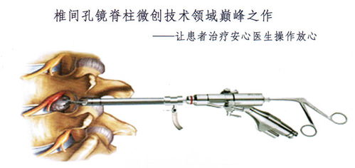 腰椎间盘突出症的微创治疗